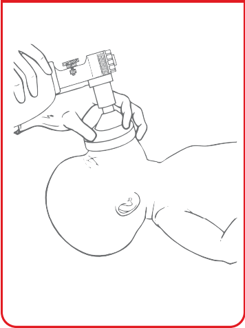 FIGURE 4. Light pressure on the mask when lifting upward on the chin
    will help create a seal. Anterior pressure on the posterior rim of the
    mandible (not shown) may also help open the airway.